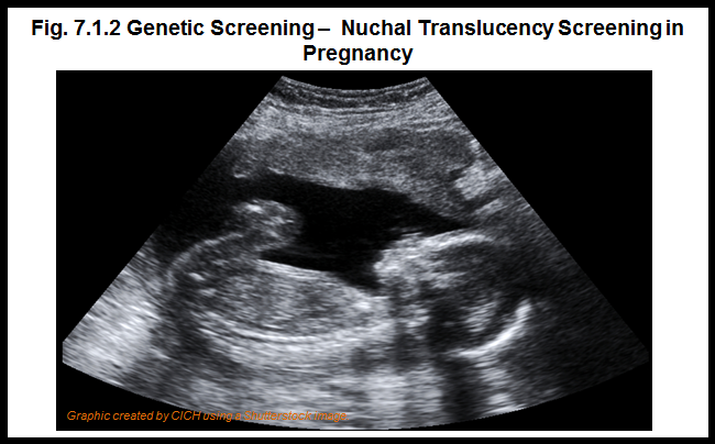 What is nuchal translucency screening